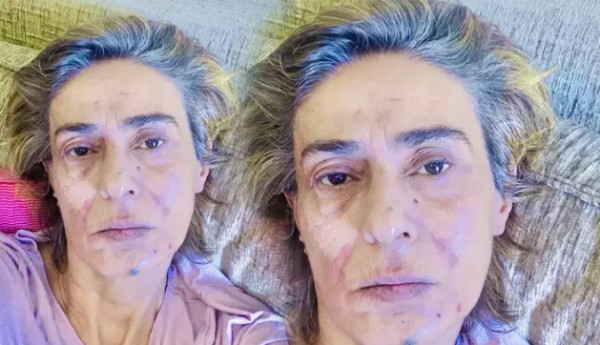 Yıldız Tilbe'nin yüzüne ne oldu?